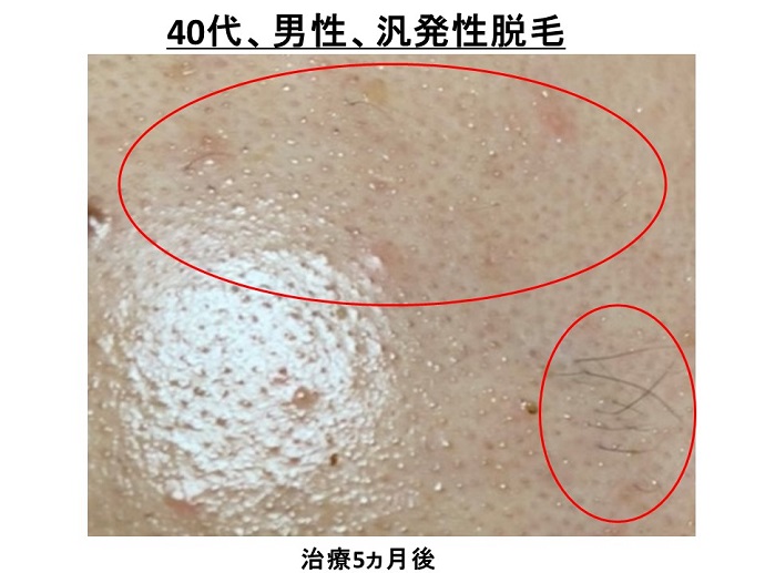 円形脱毛症　病院